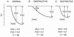 Is Obstructive Ventilatory Defect?