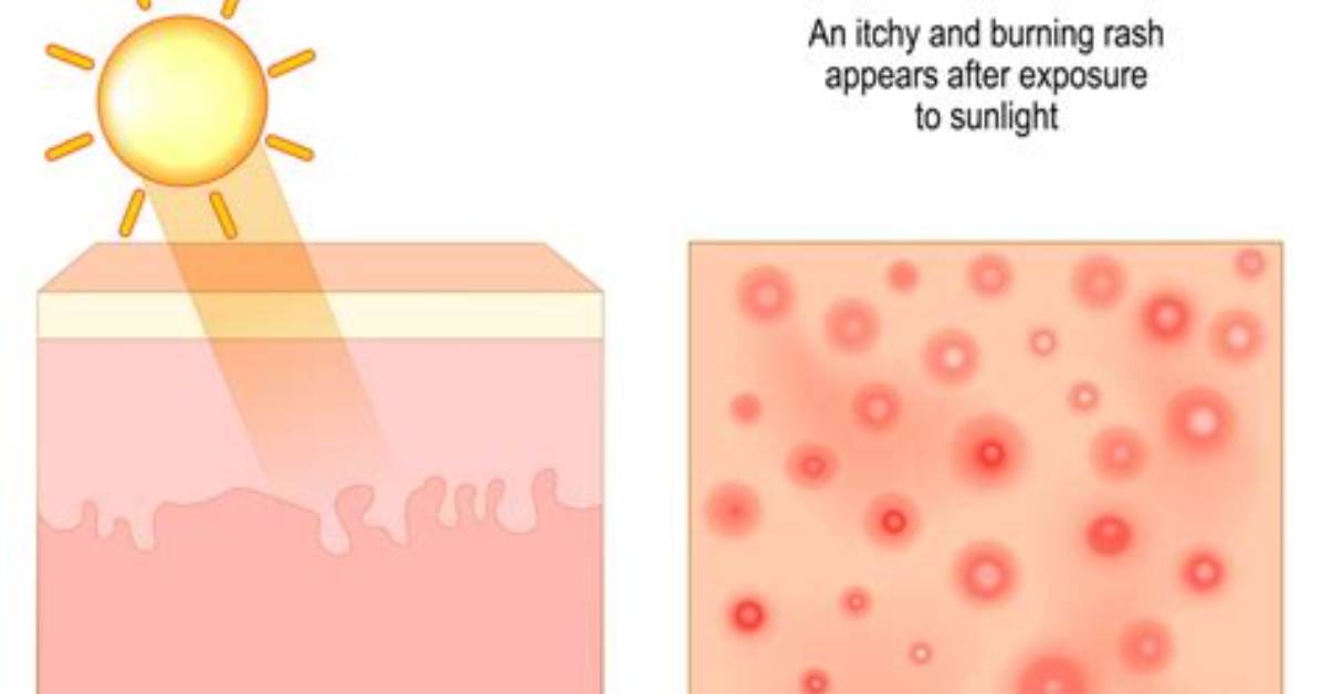 Is Polymorphous Light Eruption Permanent?