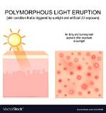 Is Polymorphous Light Eruption Permanent?