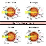 Is Presbyopia a Refractive Error?