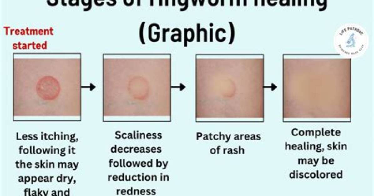 Is Ringworm Self Limiting?