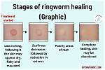 Is Ringworm Self Limiting?