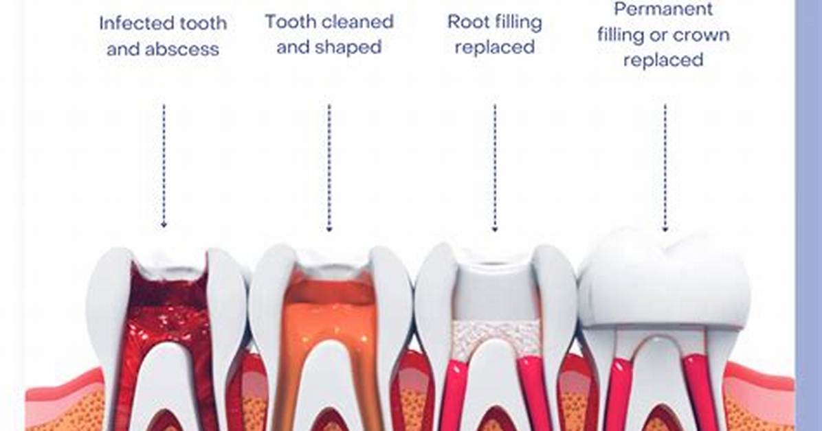 Is Root Canals Necessary?