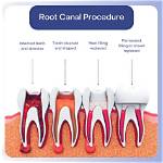 Is Root Canals Necessary?