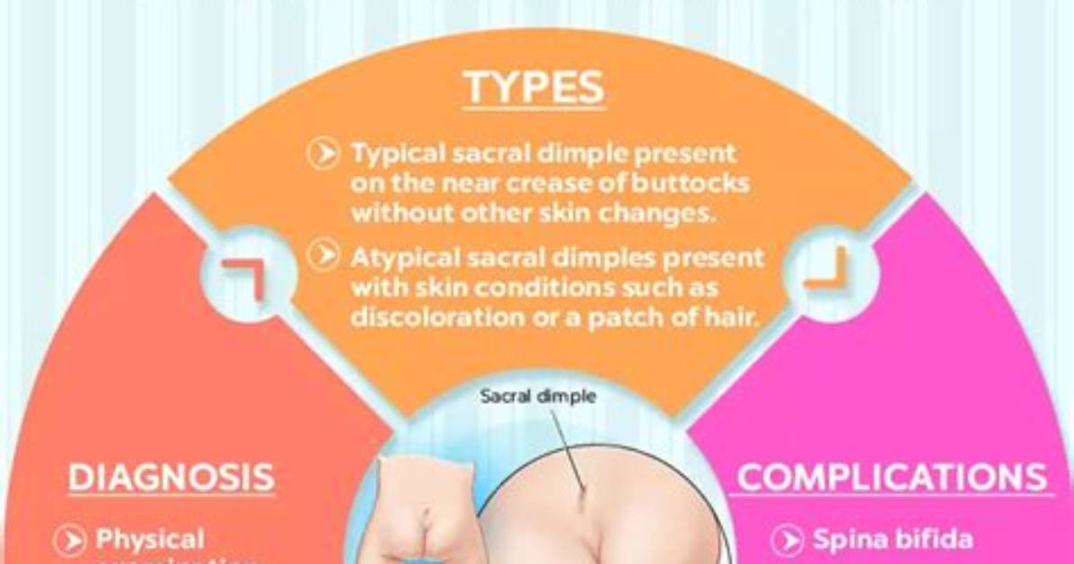 Is Sacral Dimple Common?