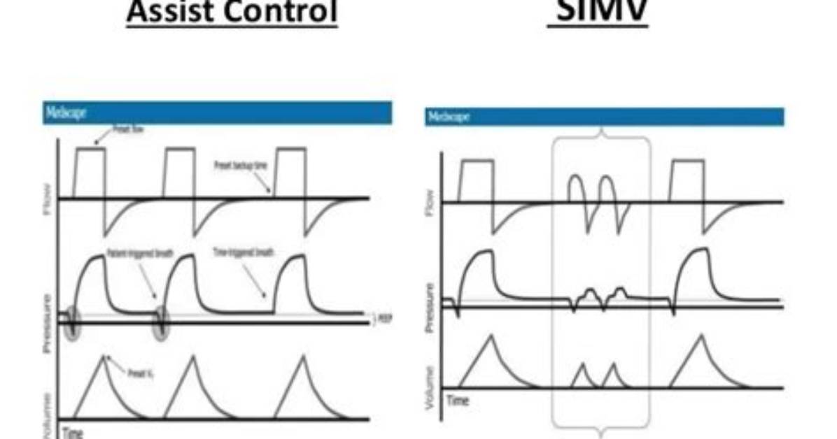 Is Simv Volume Control? | Contextresponse. Com