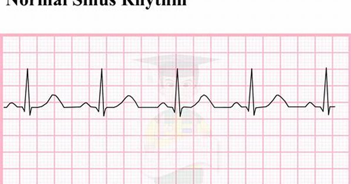 Is Sinus Rhythm Normal