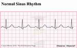 Is Sinus Rhythm Normal
