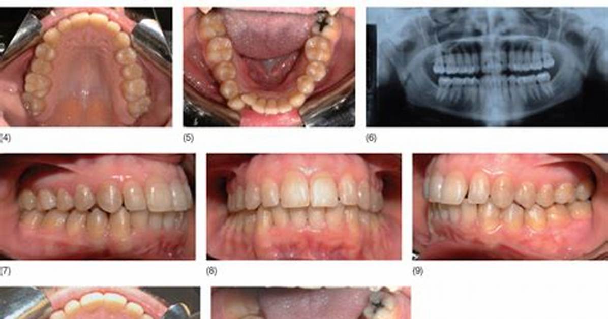 Is Slenderizing Teeth Safe?