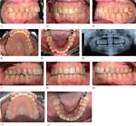 Is Slenderizing Teeth Safe?