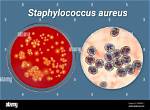 Is Staphylococcus Aureus an Std?