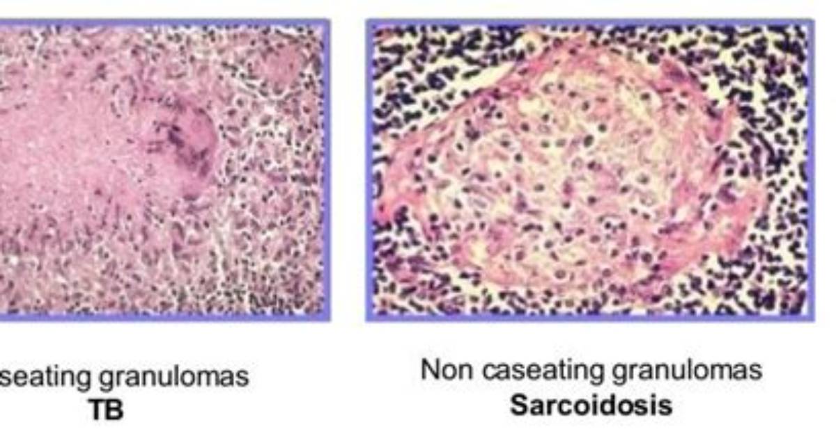 Is Tb Caseating or Noncaseating?