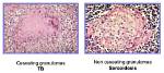 Is Tb Caseating or Noncaseating?