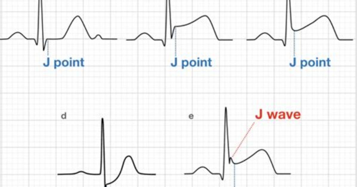 J Point Ecg