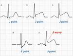 J Point Ecg