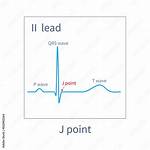 J Point