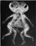 Jean Libbera: Anomaly, Physical Condition, Conjoined Twins, Family, Performances, Marriage, Wife, Children and Other Updates
