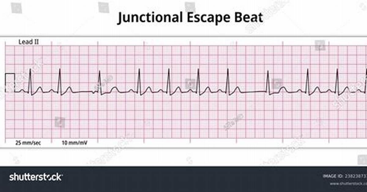Junctional Escape Beat