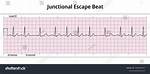 Junctional Escape Beat