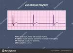 Junctional Rhythm