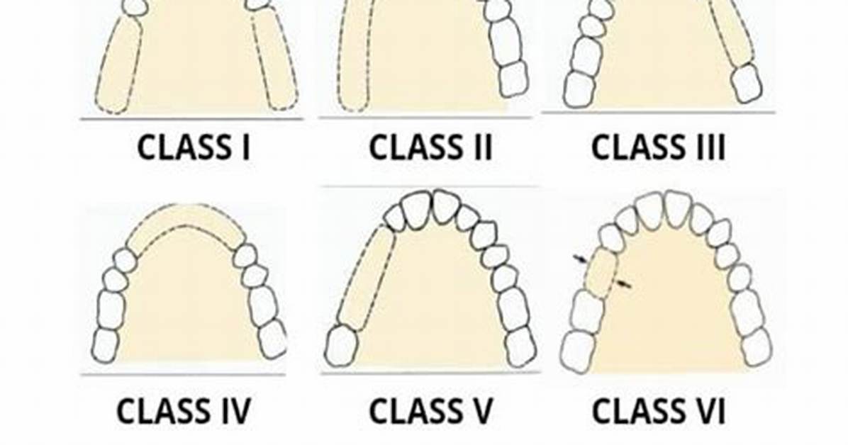 Kennedy Classification