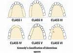 Kennedy Classification