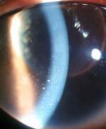 Keratic Precipitates