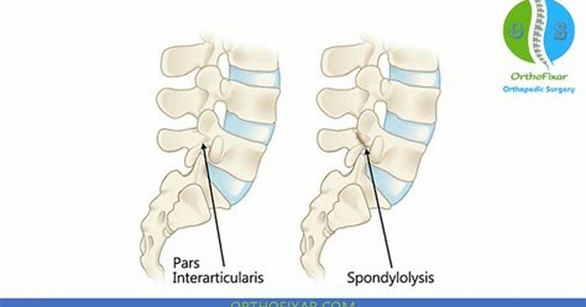 L5 Pars Defect