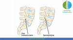 L5 Pars Defect