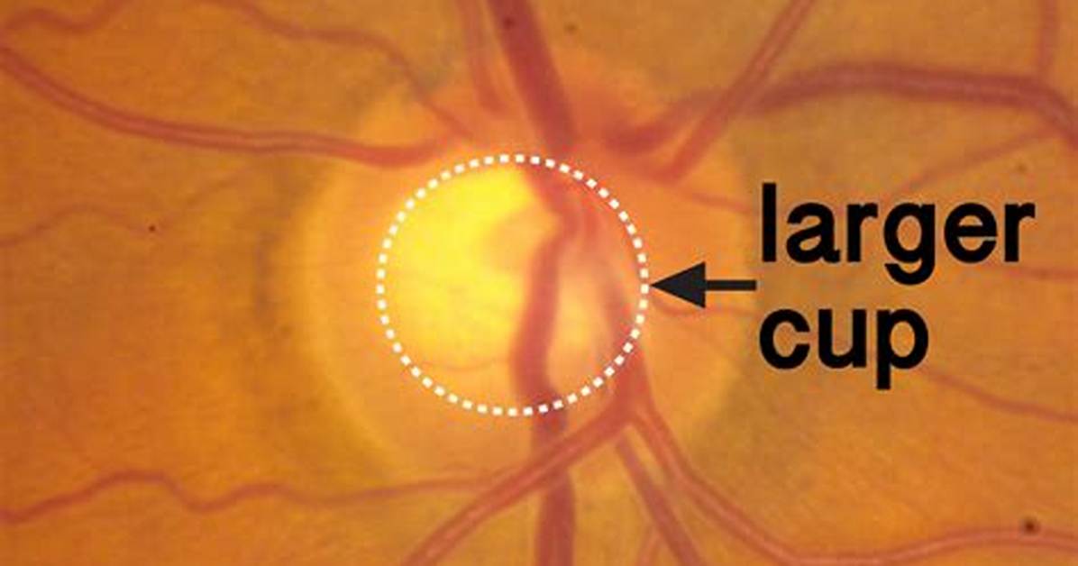 Large Optic Nerve