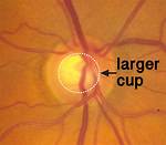 Large Optic Nerve
