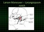 Larson Maneuver