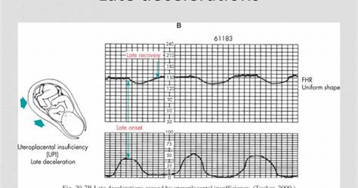 Late Decelerations Causes