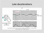 Late Decelerations Causes