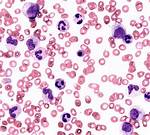 Leukoerythroblastic