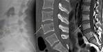 Limbus Vertebra