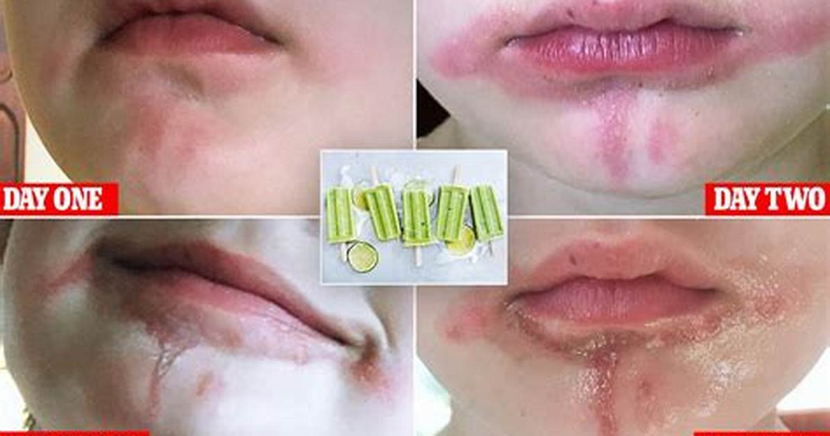 Lime Burn