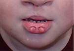 Lip Pits