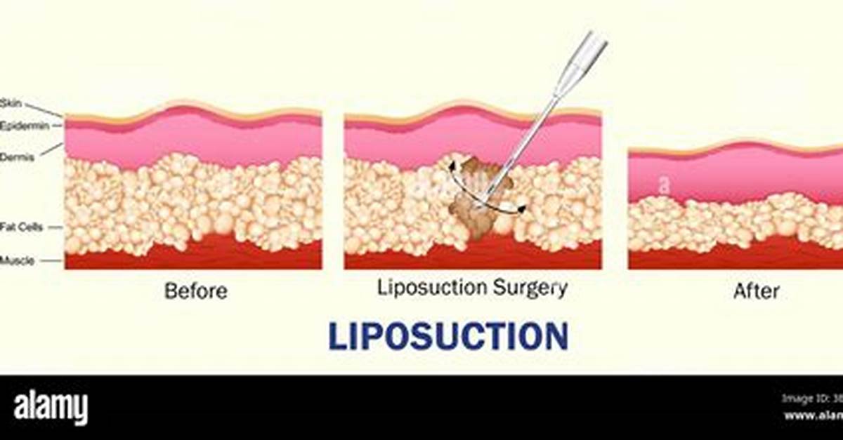 Liposuction Can Remove It
