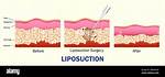 Liposuction Can Remove It