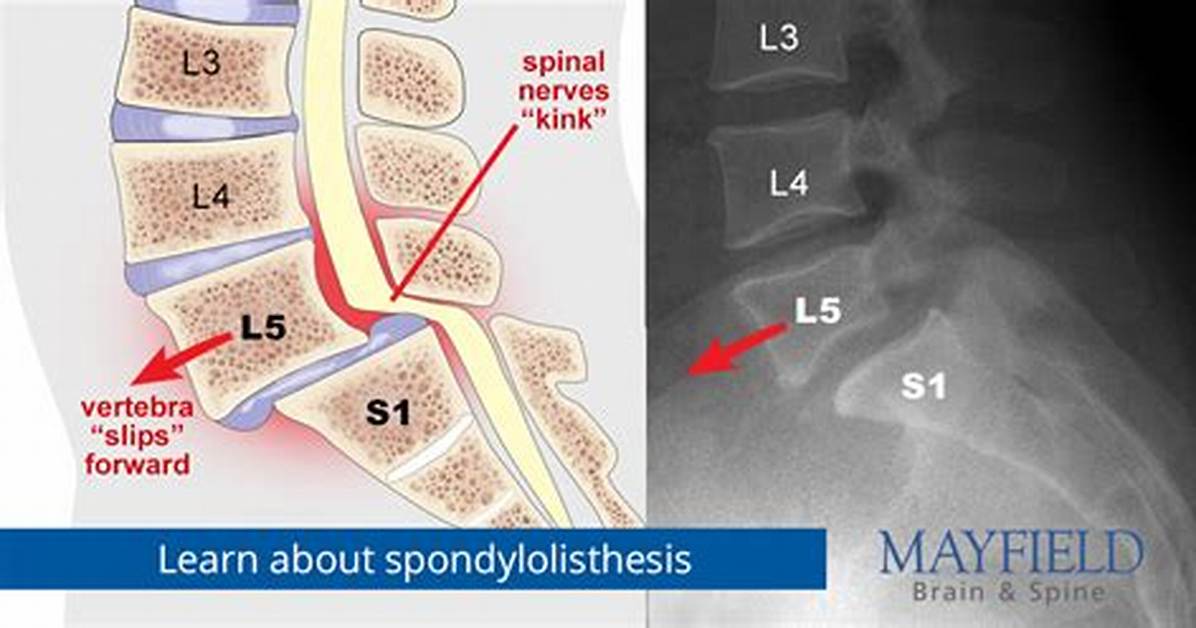 Listhesis