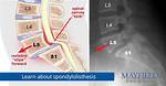 Listhesis