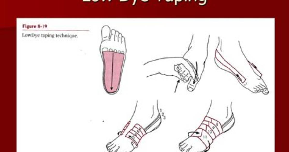 Low Dye Taping