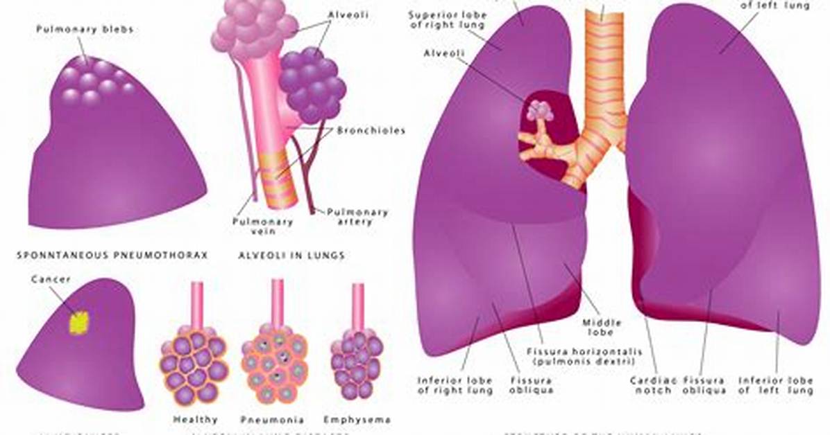 Lung Bleb