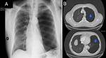Lung Bullae