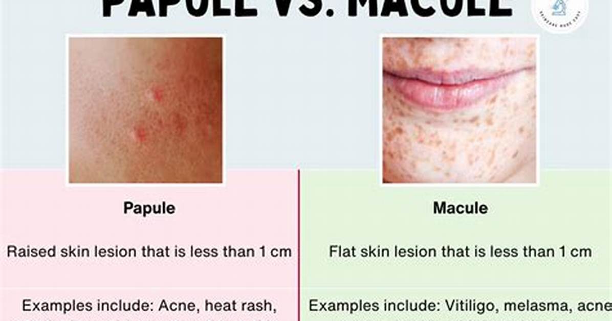 Macule Papule