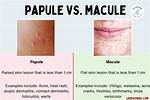 Macule Papule