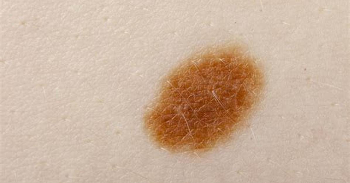 Macule Skin