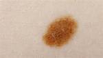 Macule Skin