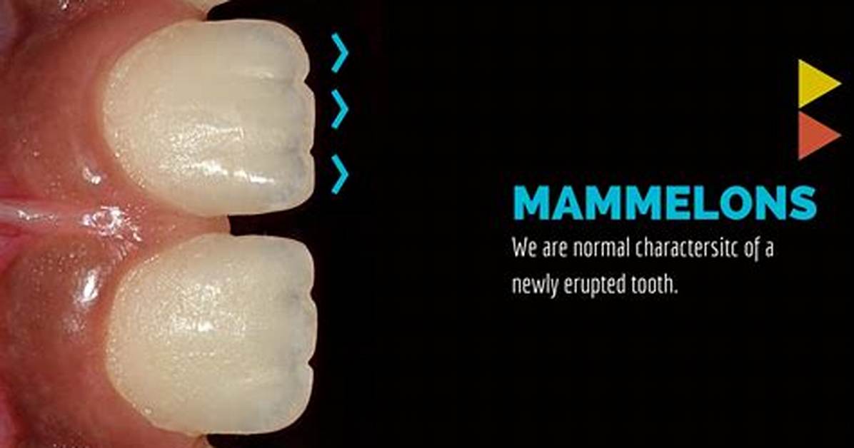 Mamelons Teeth
